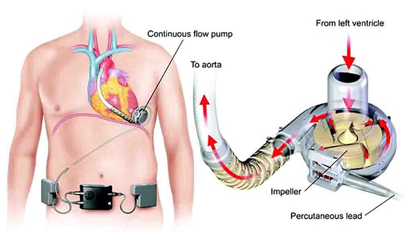 Medtronic Heart Pump Recall Deemed LifeThreatening by FDA