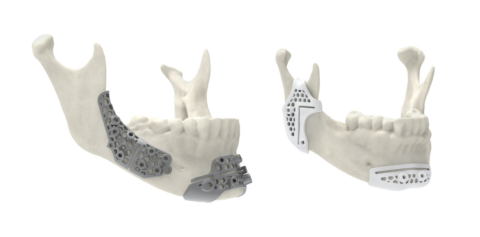 Maxillofacial surgical guides 3D printed using 3D System&rsquo;s LaserForm Ti and DuraForm ProX PA materials allow for more innovative designs that improve performance.