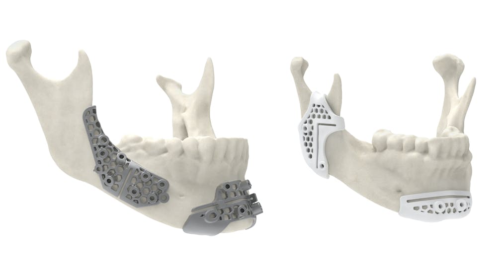 Maxillofacial surgical guides 3D printed using 3D System&rsquo;s LaserForm Ti and DuraForm ProX PA materials allow for more innovative designs that improve performance.