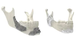 Maxillofacial surgical guides 3D printed using 3D System’s LaserForm Ti and DuraForm ProX PA materials allow for more innovative designs that improve performance.