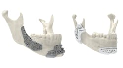 Maxillofacial surgical guides 3D printed using 3D System&rsquo;s LaserForm Ti and DuraForm ProX PA materials allow for more innovative designs that improve performance.
