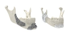 Maxillofacial surgical guides 3D printed using 3D System’s LaserForm Ti and DuraForm ProX PA materials allow for more innovative designs that improve performance. Maxillofacial surgical guides 3D printed using 3D System’s LaserForm Ti and DuraForm ProX PA materials allow for more innovative designs that improve performance.