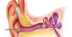 PhonoGraft being inserted into ear. PhonoGraft being inserted into ear.
